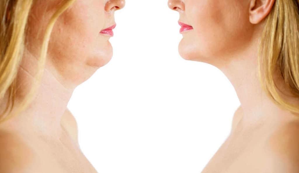 Double Chin treatment Ilkeston before and after results