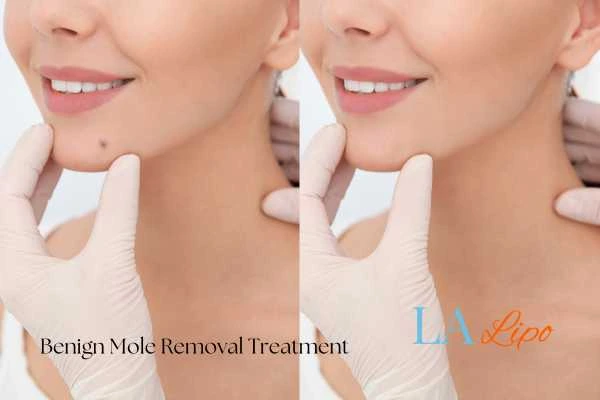 woman's before and after mole removal Ilkeston results