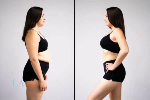 image of woman before and after results of LA-EMS Body Sculpting Ilkeston to help treat Diastasis recti