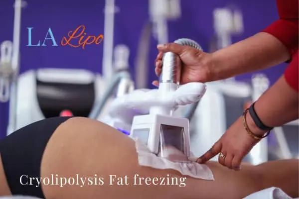 women getting fat freezing Ilkeston