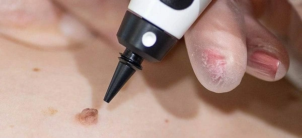 skin tag removal using cryopen Ilkeston