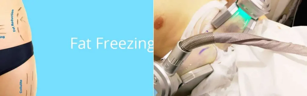 Fat freezing Ilkeston on multiple areas of the body