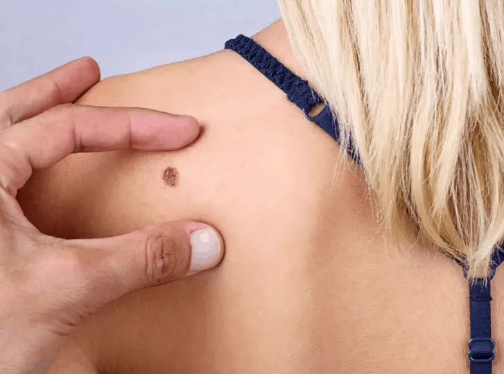 woman having mole removal Ilkeston consultation before treatment.