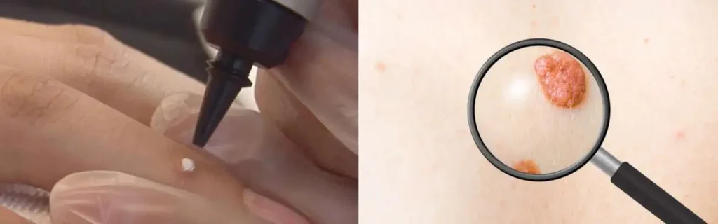 Cryopen for mole removal Ilkeston - speak to our team today!