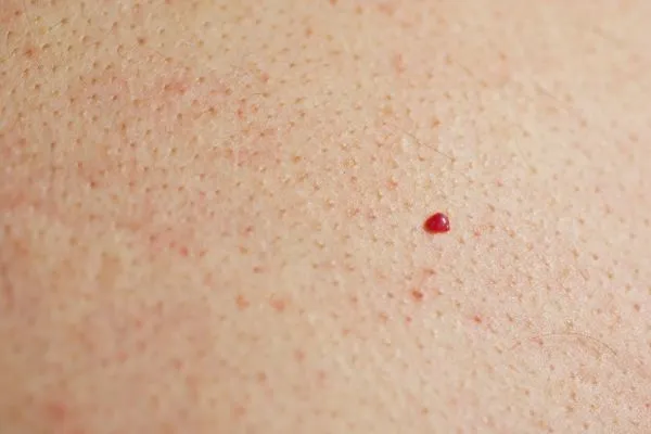 close up of a cherry angioma Ilkeston
