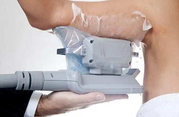 Picture of fat freezing Ilkeston on the upper arms.