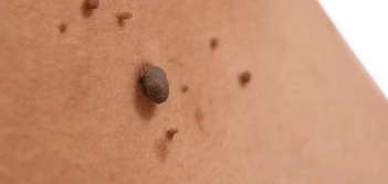 image of a skin tag Ilkeston