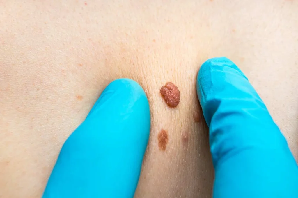 Consultant examining a skin tag Ilkeston