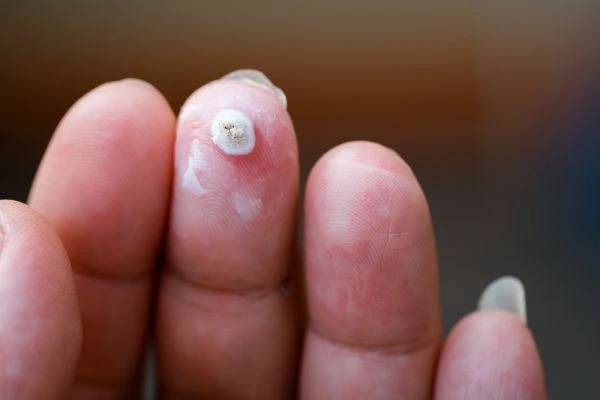 wart on person finger - cryotherapy to treat from LA LIPO Ilkeston