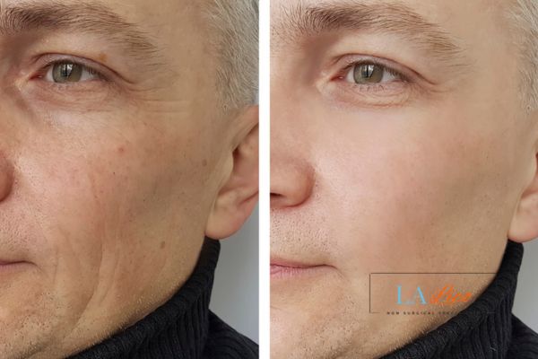 See the amazing results of Morpheus8 Treatment Ilkeston!