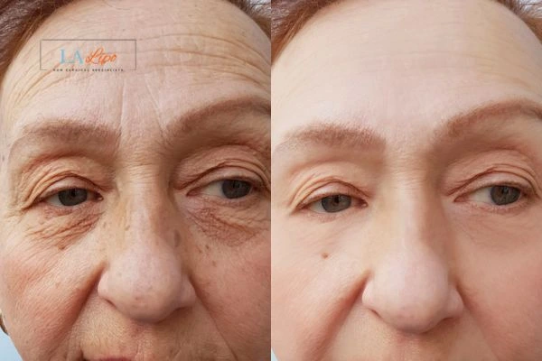 The powerful benefits of Morpheus8 Treatment Ilkeston - Call Our team today!