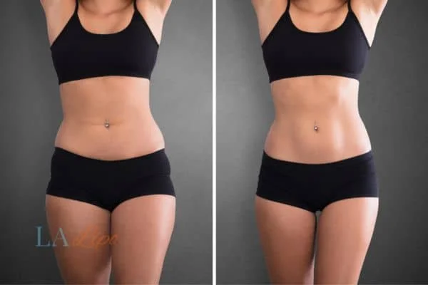 before and after results of non-surgical treatment to help a woman's body image and mental health Ilkeston