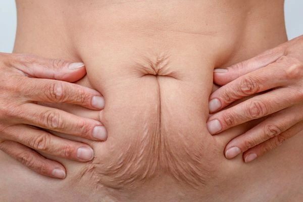 Image of a woman's stomach with loose skin - example of skin tightening Ilkeston options