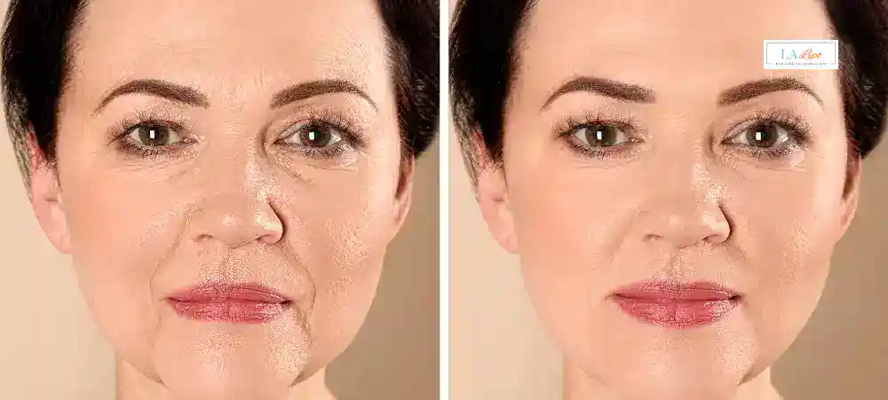 How Long Does It Take to See Results and How Long Do They Last Ilkeston?